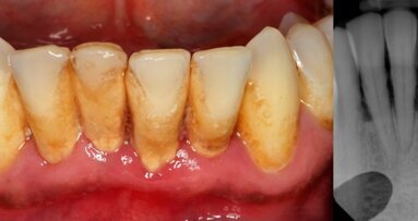 Allogenic stem cells – a faster and cheaper method to treat periodontitis