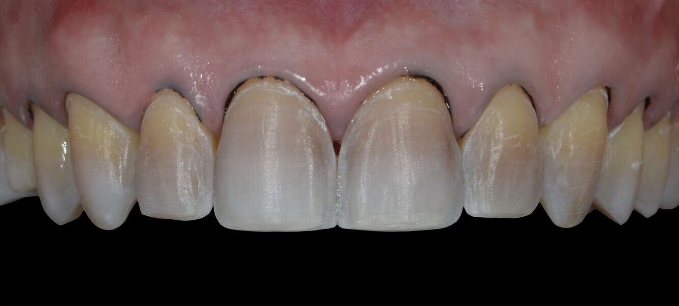 Fig. 10: Final preparation.