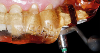 Tříčlenný můstek v distálním úseku na implantátech Straumann BLX s okamžitě nasazenou provizorní náhradou: kazuistika krok za krokem