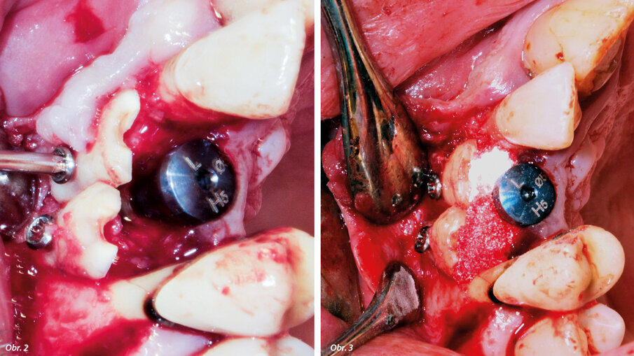 Orientace štěpů. Prostor mezi štěpem a hřebenem zaplněný výplňovým materiálem.
