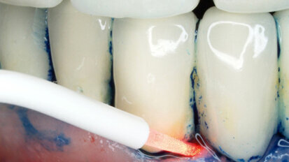 La terapia fotodinamica antimicrobica nel trattamento della perimplantite