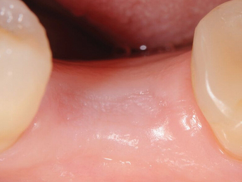 Fig. 2: Four months post extraction. (Photo: Jens Tartsch, DMD)