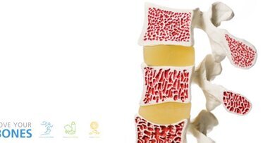 Drei Schritte zu unzerbrechlichen Knochen