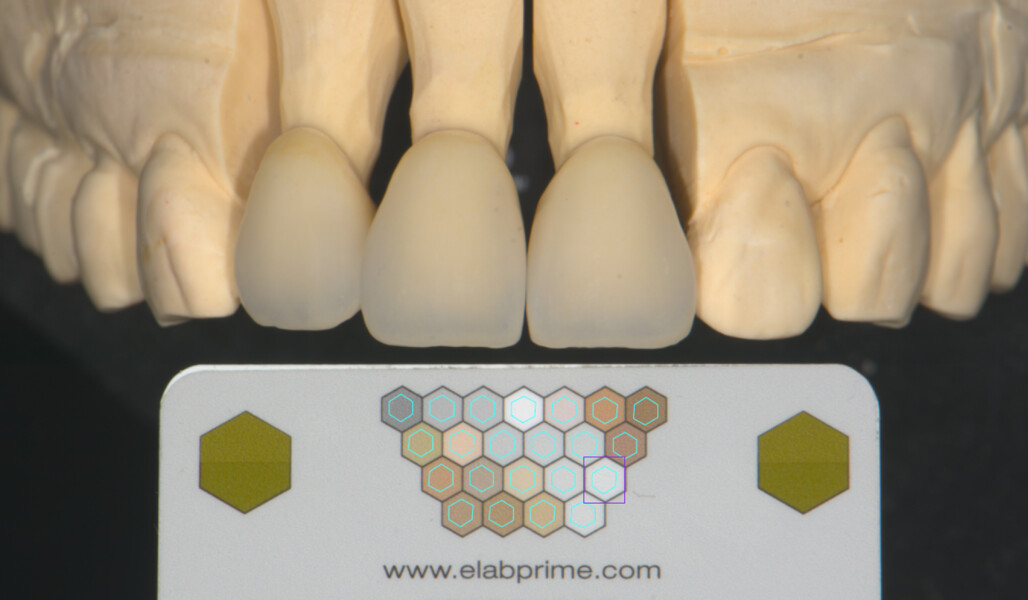 Fig. 5: Layering procedure: shade verification.