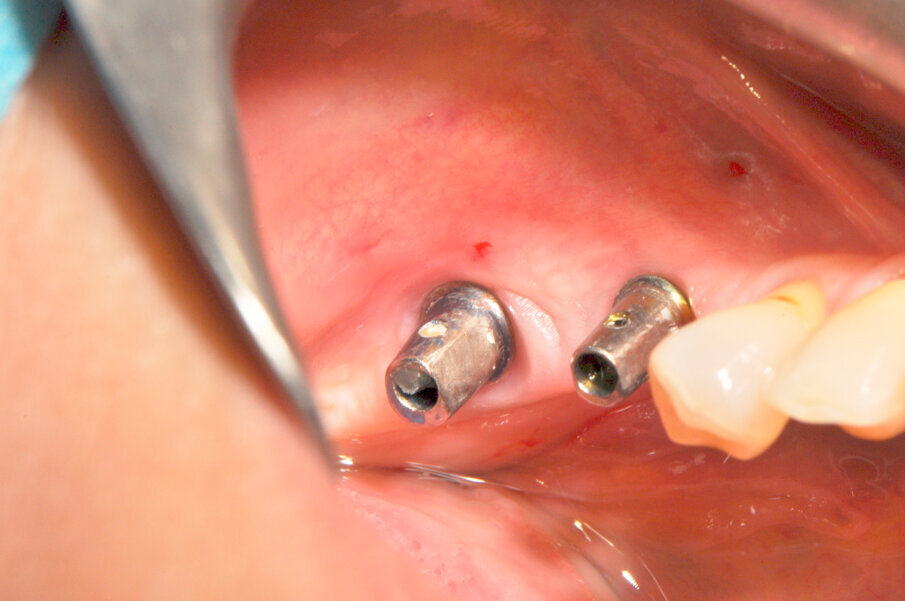 Fig. 2 – Aspetto clinico delle mucose perimplantari al momento dell’atto chirurgico.