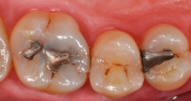 Nuovo metodo per restauro in composito diretto nei settori latero-posteriori