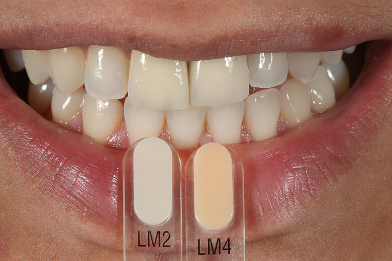 Fig. 3. Las guías de color VITA VMK Master LUMINARY se utilizaron para determinar los efectos de fluorescencia.