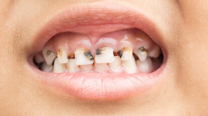 Studie zeigt: Der Alltag ist entscheidend für gesunde Kinderzähne