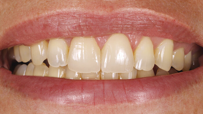 Fig. 16: Result: The curve of the incisal edges harmonized with the curve of the lips.
