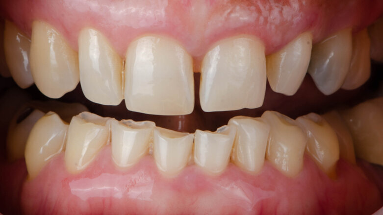 Understanding how bruxism affects dental restorations