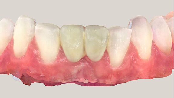 Optimising design and shade—replacement of a resin-bonded bridge for aesthetic reasons