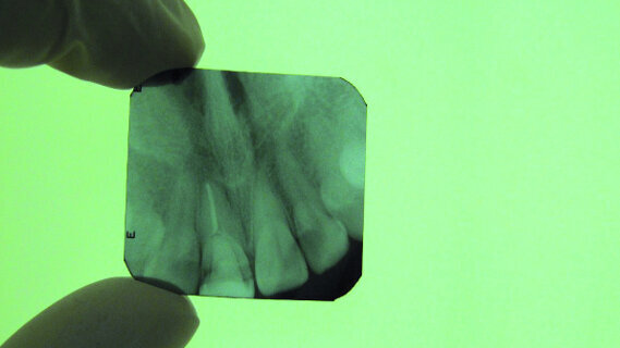 Ostéo-intégration assistée par laser : une diode laser pour la pose d’un implant de type I