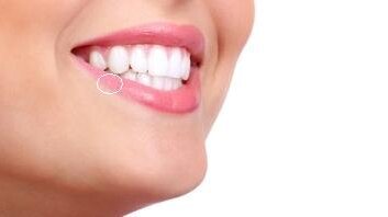 Wirus opryszczki może pomóc w leczeniu nowotworów jamy ustnej