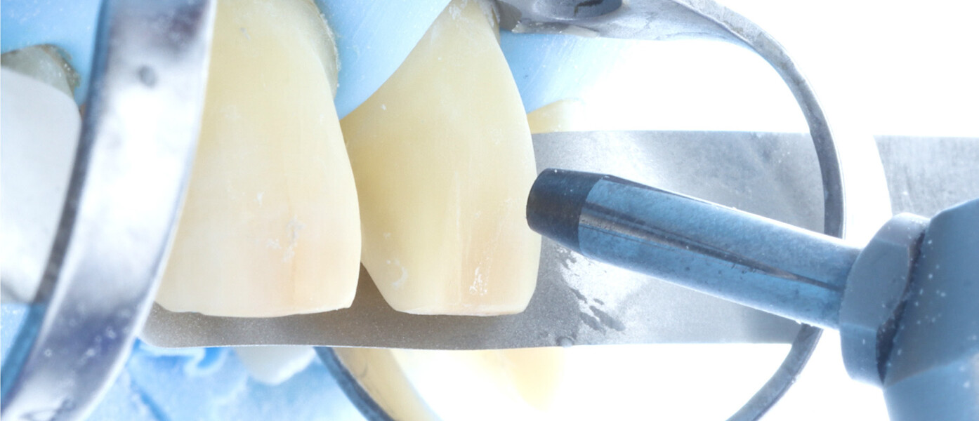 Fig. 14a: Air abrasion of the prepared tooth surfaces using a 35 μm aluminium oxide powder.