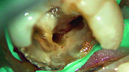 The role of the operating microscope - in conjunction with ultrasonic in preparation of root canal systems