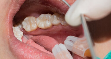 Von der Matrize bis zur Füllung: So gelingt die Seitenzahnrestauration