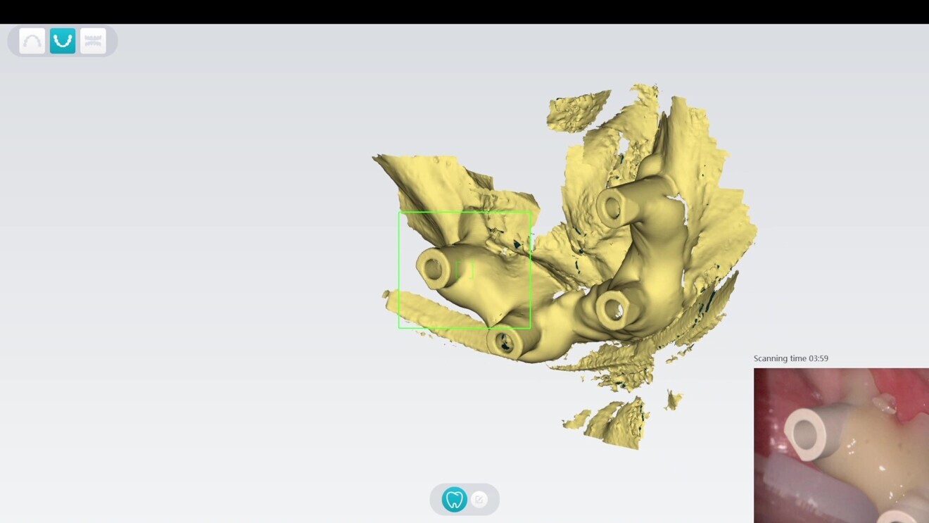 Fig. 4: Splinted scan bodies in the lower jaw.