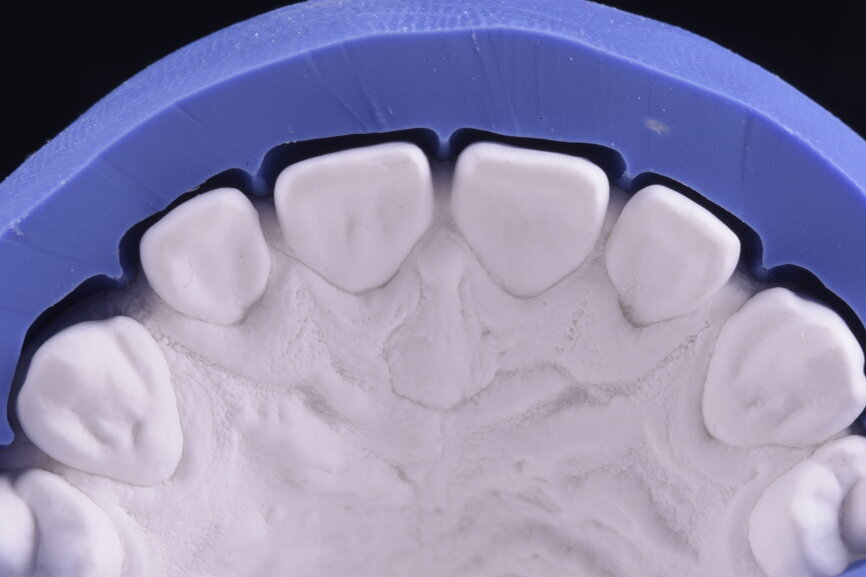 Fig. 34: Sectioned silicone key on the plaster model for laboratory
reduction.