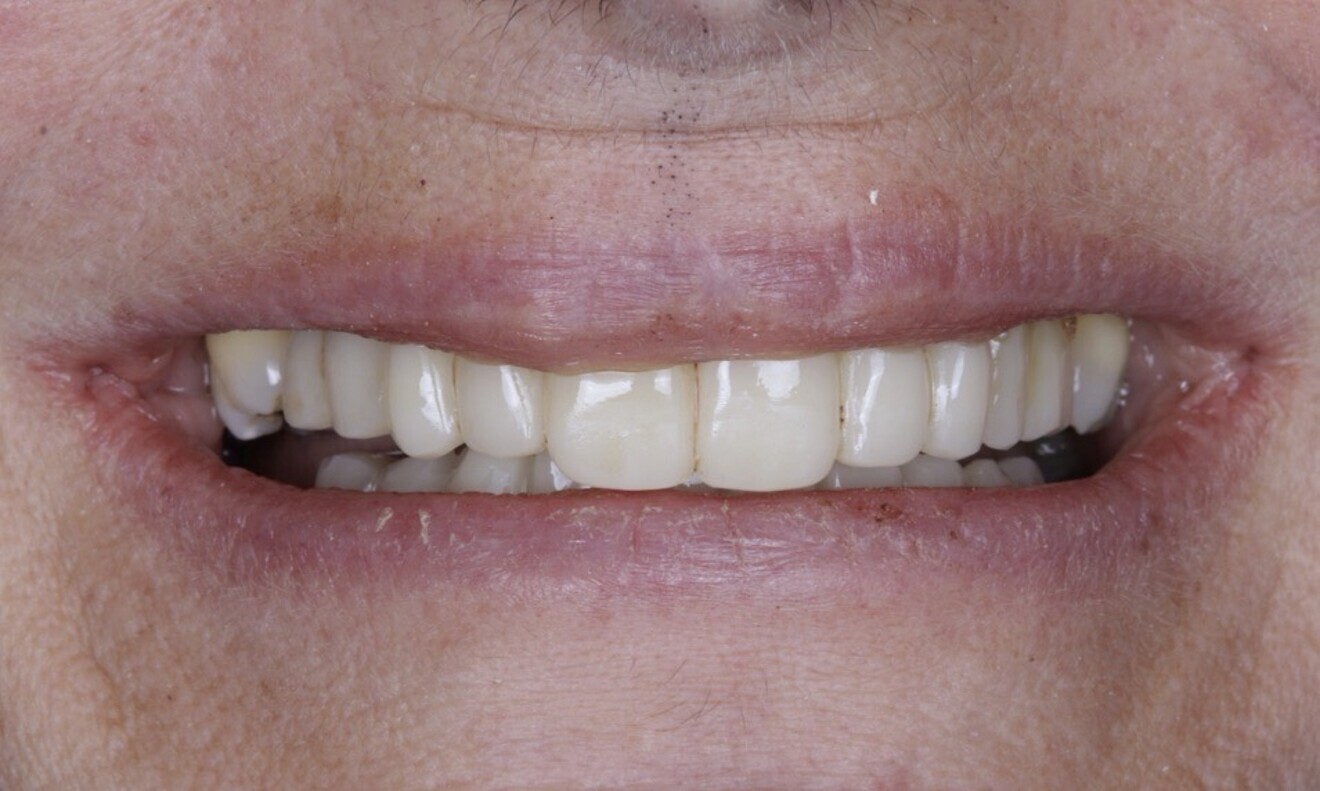 Fig. 67: At the suture removal appointment, excellent healing was observed, ...