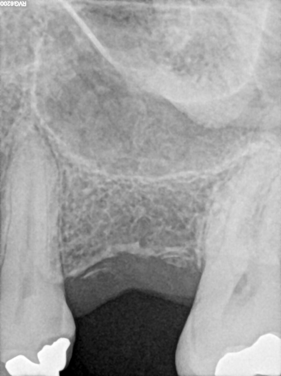 Fig. 2_Radiografia endorale iniziale.
