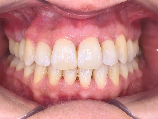 Photo de face en fin de traitement (Copyright : Dr Edouard Negre)