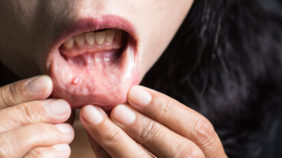 Researchers develop new method for identifying oral cancer