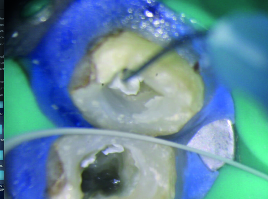 Fig. 8 : Mise en place du dispositif de lasso EndoCowboy autour du segment coronaire du fragment. 