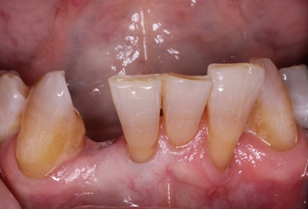Fig. 2: Healed extraction site eight weeks after extraction of tooth #42.