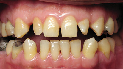 Mock-up: Vaše každodenní pomůcka v estetické stomatologii