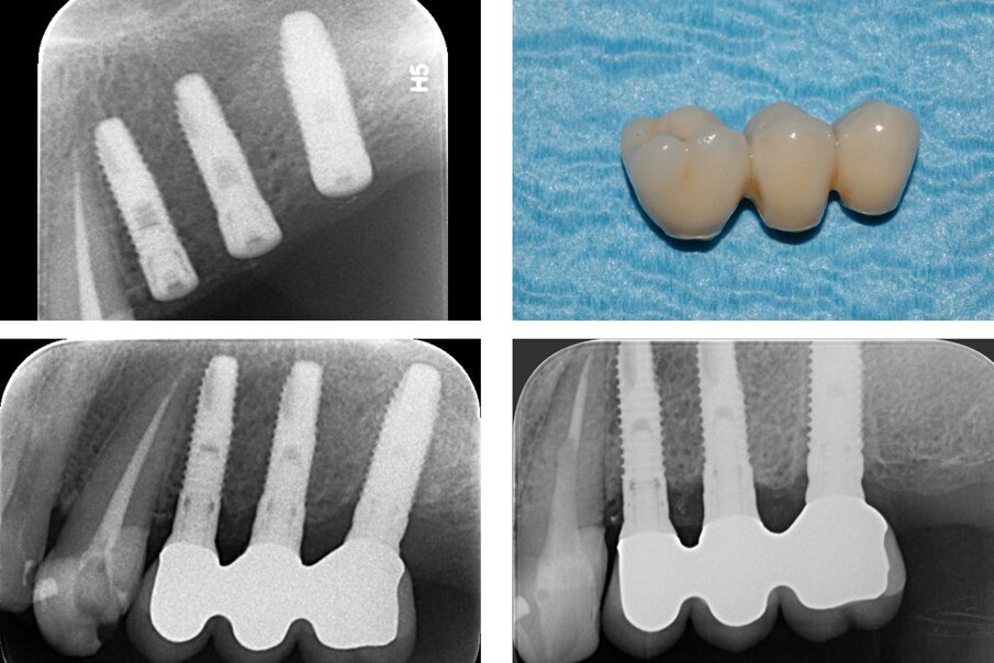 Fig. 7_Endorale al termine dell’intervento (in alto a sinistra); la protesi definitiva e due endorali di controllo scattate a un anno (in basso a sinistra) e sette anni (in basso a destra) dal posizionamento implantare. I livelli ossei perimplantari appaiono sostanzialmente invariati. 
