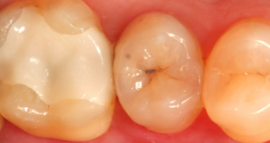 Una nueva técnica para eliminar la caries