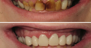 Dúo de expertos: el software y los dientes provisionales