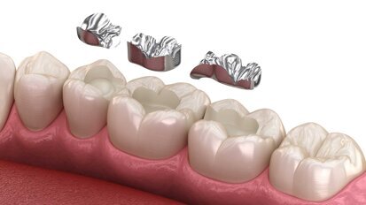 Keine Lösung in Sicht: Verhandlungen über Amalgam-Ersatz abgebrochen
