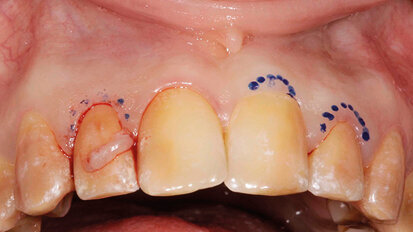 Trattamento estetico-funzionale in un caso di amelogenesi  imperfetta generalizzata
