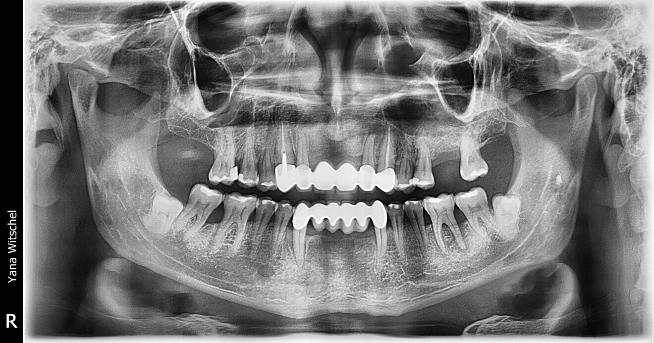 Fig. 5: Panoramic radiograph after treatment.