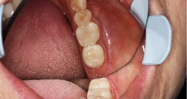 Scan perfectly with CEREC Primescan, and gain time for what is really important: your patients