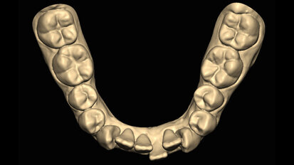 Hybridní terapie alignery