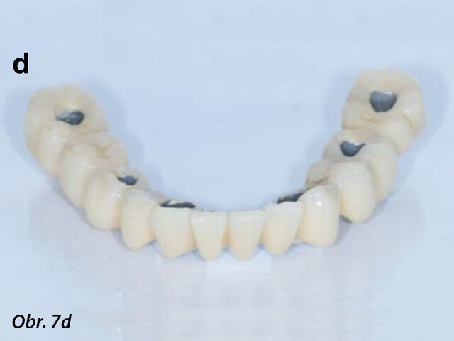 CAD/CAM model s prefabrikovanými titanovými abutmenty (a), CAD/CAM chromkobaltová základní konstrukce (b) a provizorní fixní náhrada fazetovaná kompozitem (c, d) před připevněním na abutmenty.