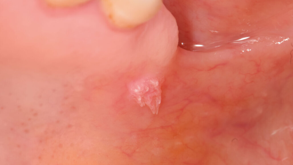 Effetti della Zn-L-Carnosina sulle lesioni della mucosa orale: case report