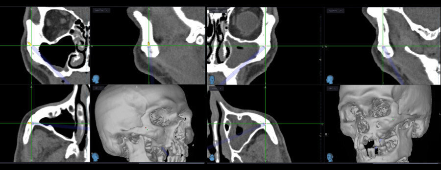 Fig. 9: Three-D intra-op images provided by the navigation system.
