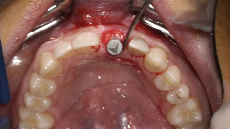 Fig. 19_Gestione del biomateriale.