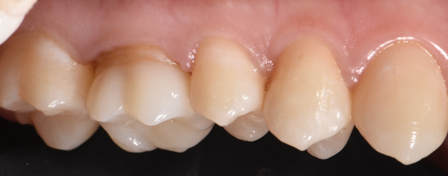 Fig. 18c: Onlay evaluated during the try-in, buccal view.
