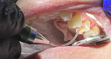 Laser treatment of pulpal exposure to potentially avoid endodontic treatment