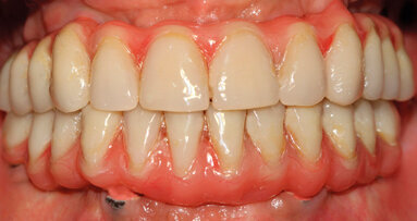 Procedura implanto-protesica a carico immediato: il successo è il sorriso del paziente