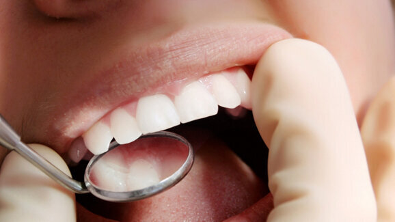 Η επίδραση της τάσης κυκλικής κόπωσης-βιοδιάβρωσης στις μη τερηδονικές αυχενικές  βλάβες