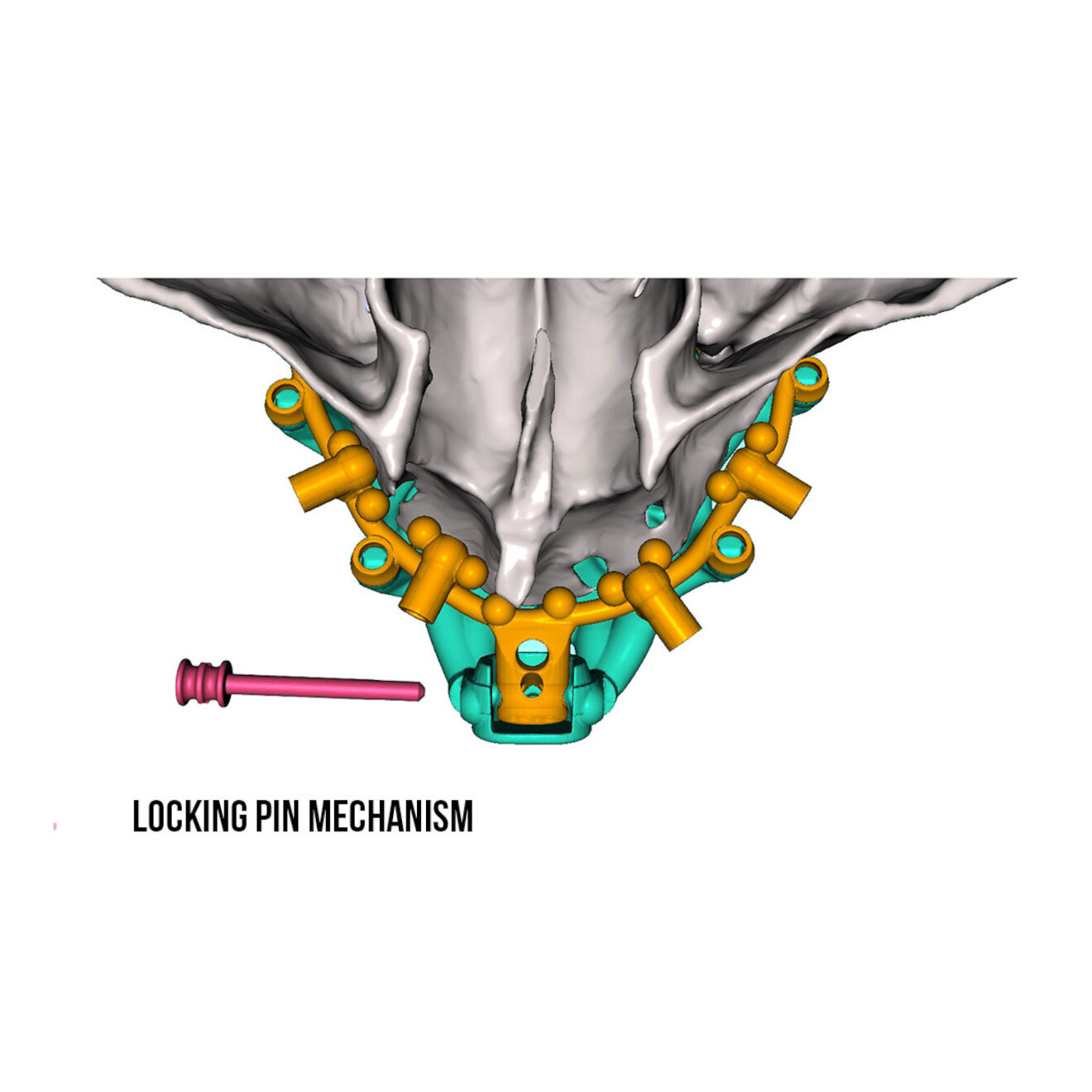 Fig. 14a: Anterior positive seat for the osteotomy drill guide provided by the slide-and-tilt mechanism.
