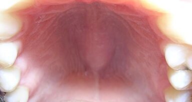 Występowanie wałów żuchwowych i podniebiennych – przegląd piśmiennictwa