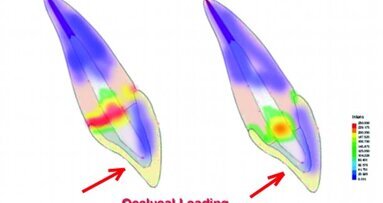 Restauration de dents traitées endodontiquement : un abord sous l’angle technique