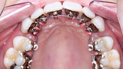 Řešení bimaxilární protruze extrakcemi a lingválním aparátem