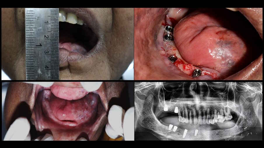Glossectomy case restored with implants 
